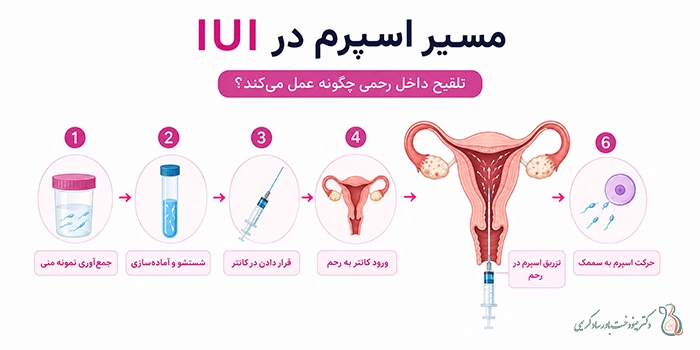 IUI چیست؟