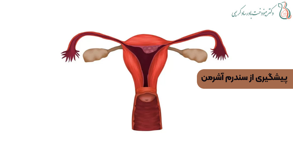 پیشگیری از سندرم آشرمن