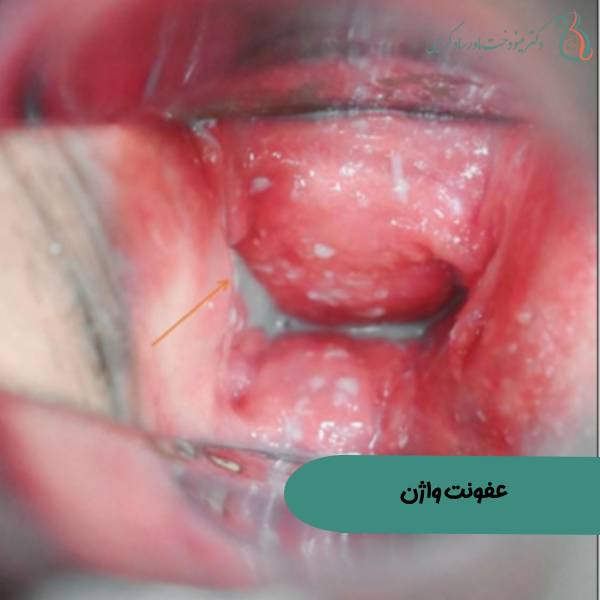 عکس عفونت واژن زنان