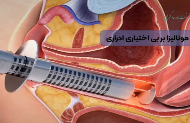 تاثیر لیزر مونالیزا بر بی‌ اختیاری ادراری