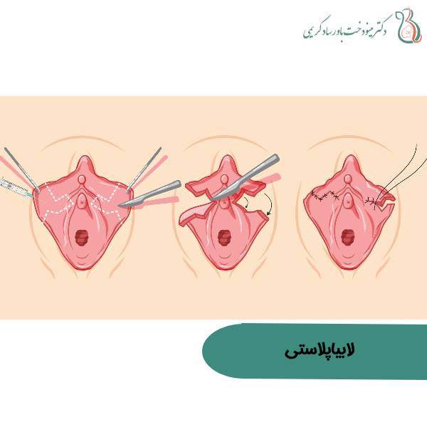 عکس لابیاپلاستی