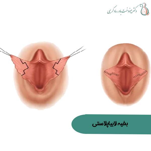 عکس بخیه لابیاپلاستی