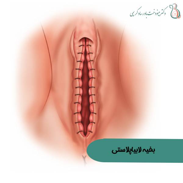 عکس بخیه بعد از لابیاپلاستی